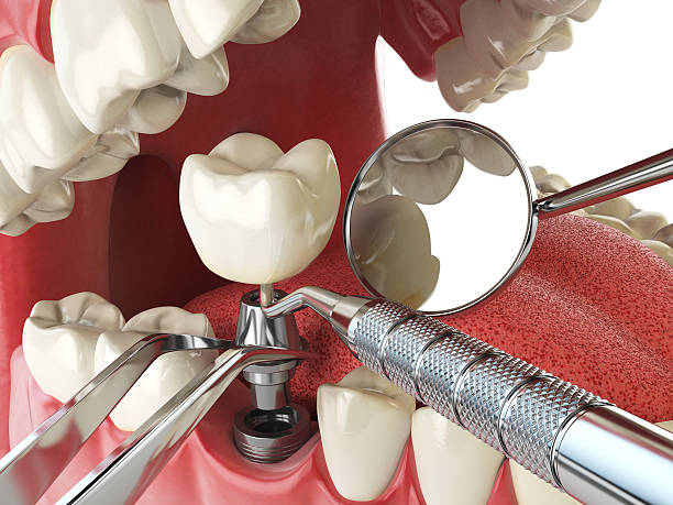 Best Emergency Treatment for Dental Infections or Abscesses in Westwego, LA
